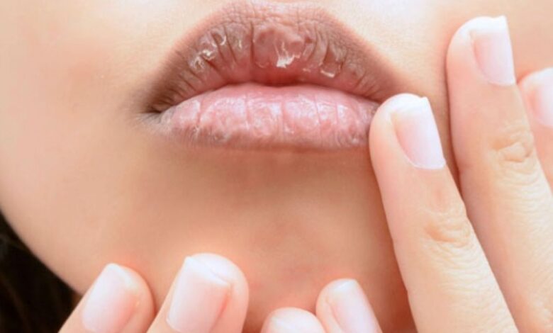 Cara alami atasi bibir kering kemudian pecah-pecah agar tampil percaya diri